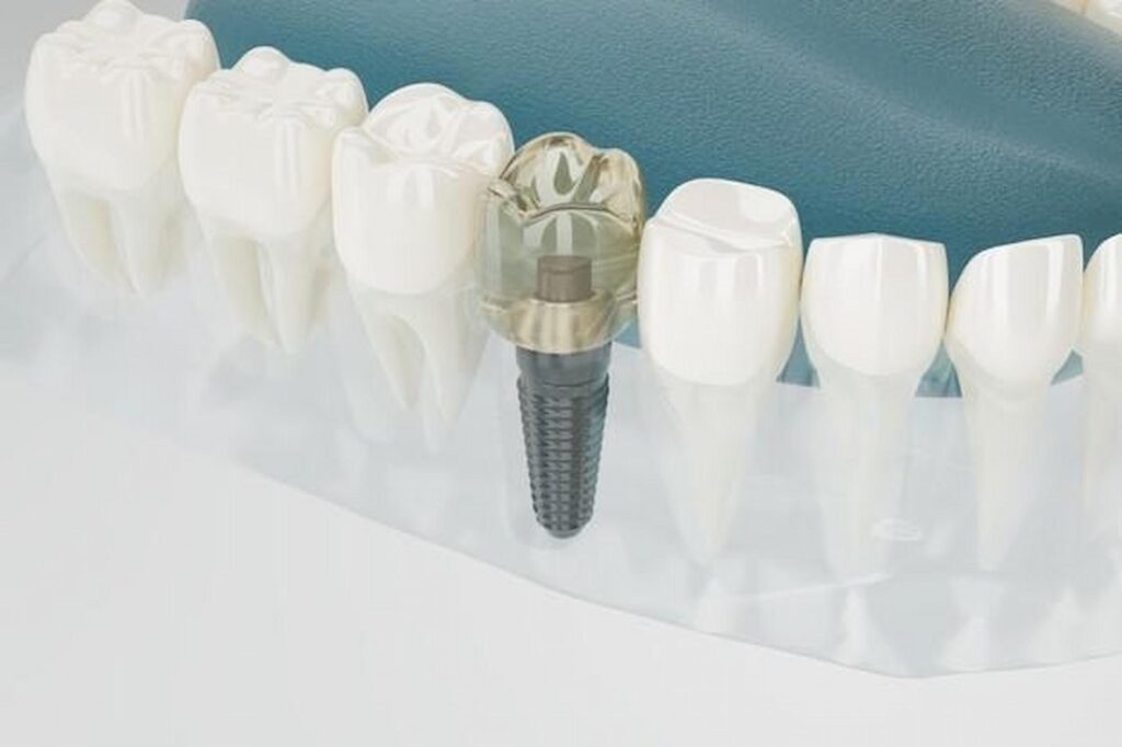 Why Restoring Smile With Dental Implant Had Been So Popular Till Now?