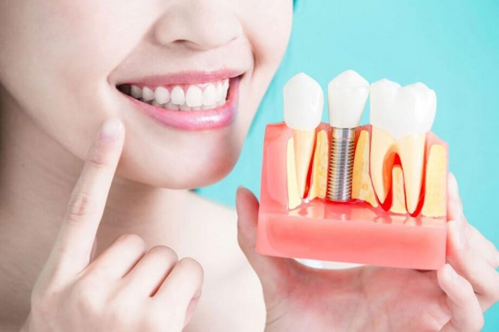 Benefits Of A Dental Implant