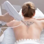 Does Tattoo Removal Hurt More Than Getting a Tattoo?