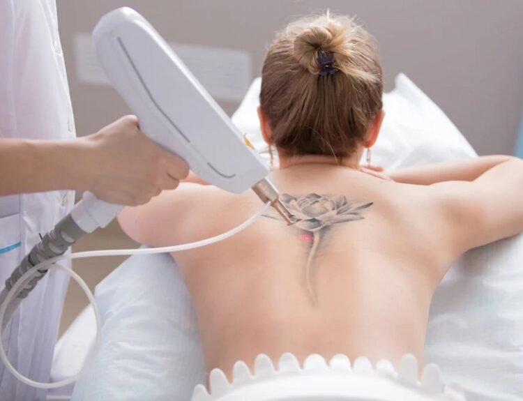 Tattoo Removal
