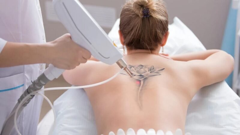 Does Tattoo Removal Hurt More Than Getting a Tattoo?